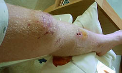 Photo 11: broken leg